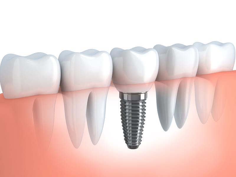 Dental Implants  Phillipsburg, NJ 