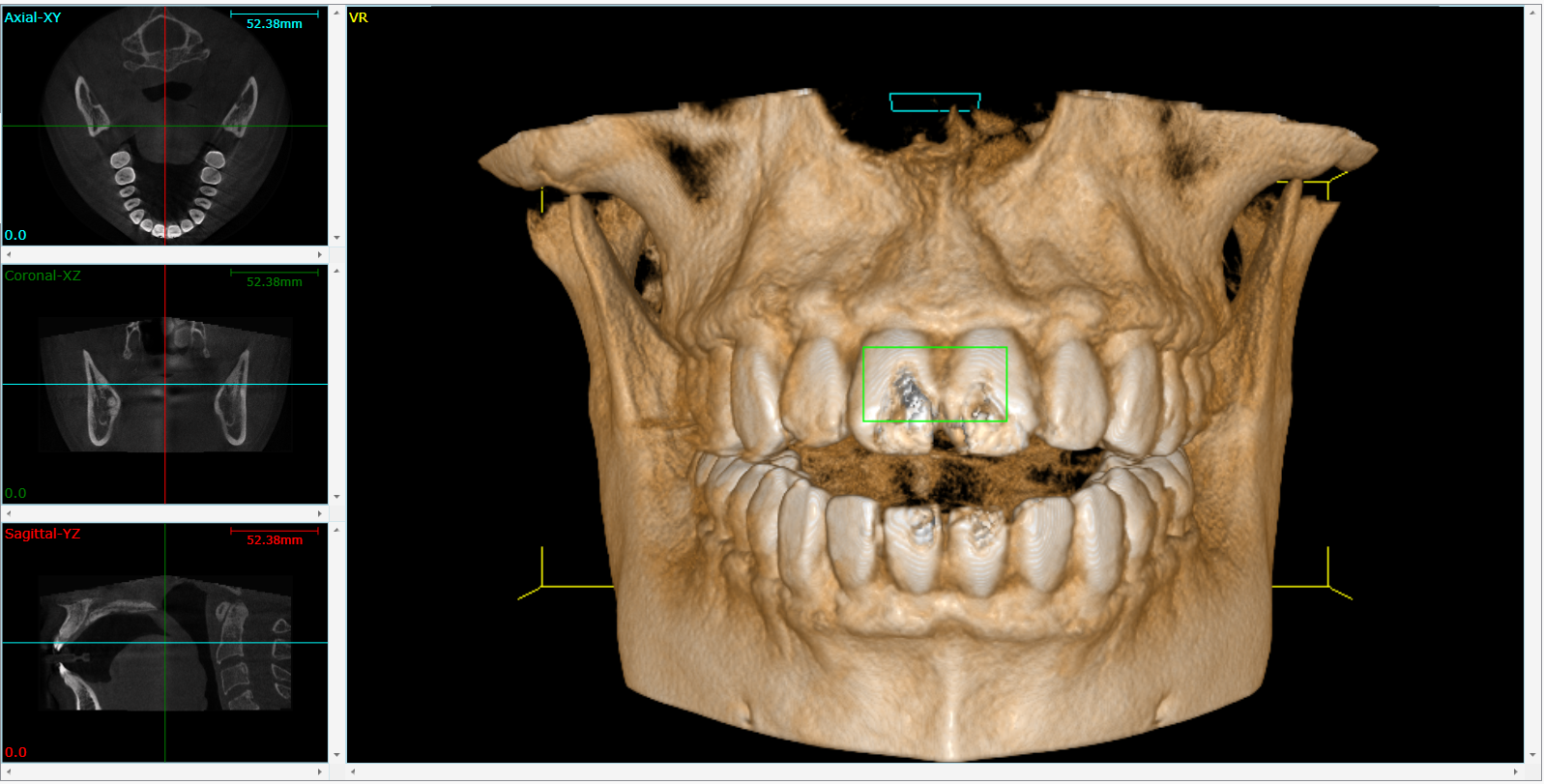 Cone Beam 3D Imaging  Phillipsburg, NJ 