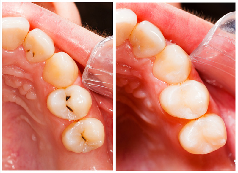 Fillings  Phillipsburg, NJ 