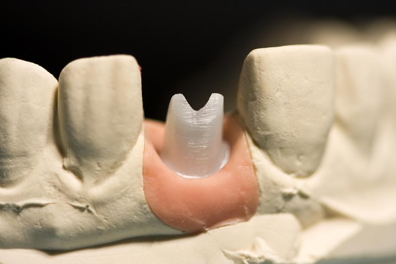 Implant Restoration  Phillipsburg, NJ 